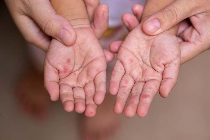 5 Yaş Altı Çocuklarda Daha Sık Görülüyor Belirtileri Arasında Ateş, Vücut Döküntüleri, Boğaz Ağrısı Var... Bu Hastalığa Dikkat