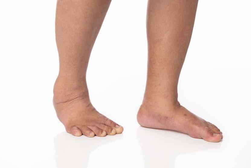 Sinsi İlerliyor... Kol ve Bacaklardaki Bu Değişime Dikkat Ciltte Akıntı, Sızıntı, Yaralar... Hepsi Bu Hastalığı İşaret Ediyor