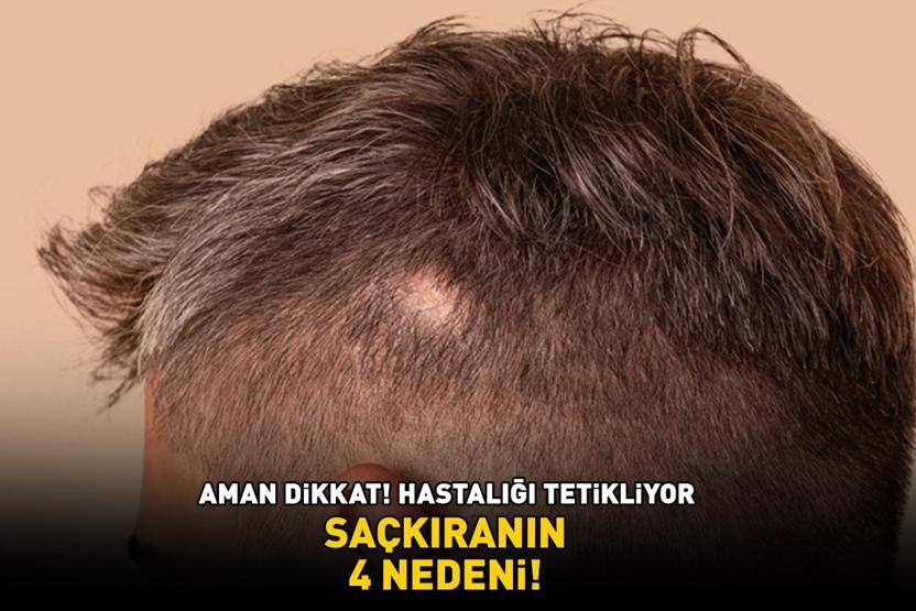 Aman dikkat Hastalığı tetikliyor SAÇKIRANIN 4 NEDENİ