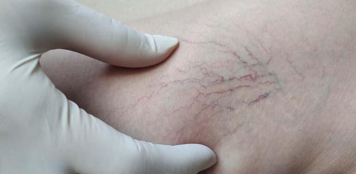 Bacaklarınızdaki kılcal damarları hafife almayın: Varis sessiz ilerliyor