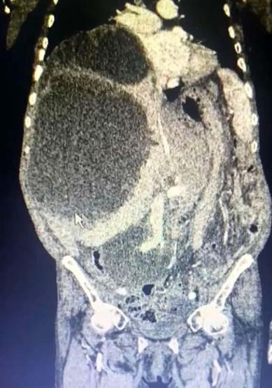Karnında Şişkinlik Ve Ağrı Şikayetiyle Hastaneye Gitti Karaciğerinden 90 Santimetrelik Kedi-Köpek Kisti Çıkarıldı