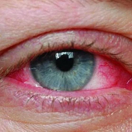 Çocuklarda görülüyor Adenovirüs havuzlardan da bulaşıyor AMAN DİKKAT GÖZÜNÜZE BULAŞMASIN