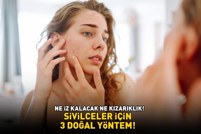 SİVİLCELER İÇİN ETKİLİ 3 DOĞAL YÖNTEM 10-15 dakika bekletmek yetiyor Ne iz kalacak ne de kızarıklık