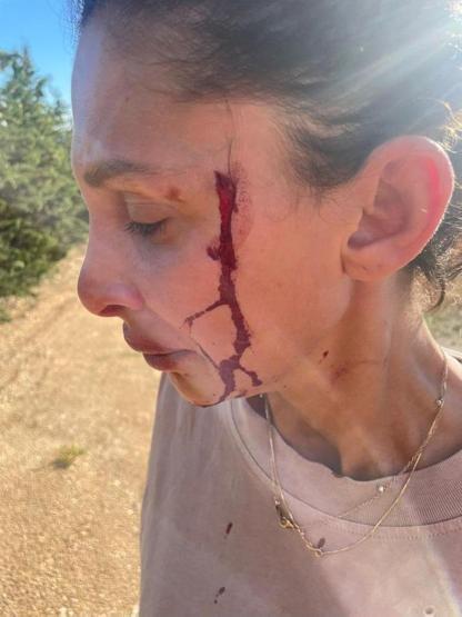 Can Yaman’ın büyük aşkı Sara Bluma kanlar içinde Ünlü oyuncu, şiddet gören sevgilisine böyle destek verdi: YANINDAYIM