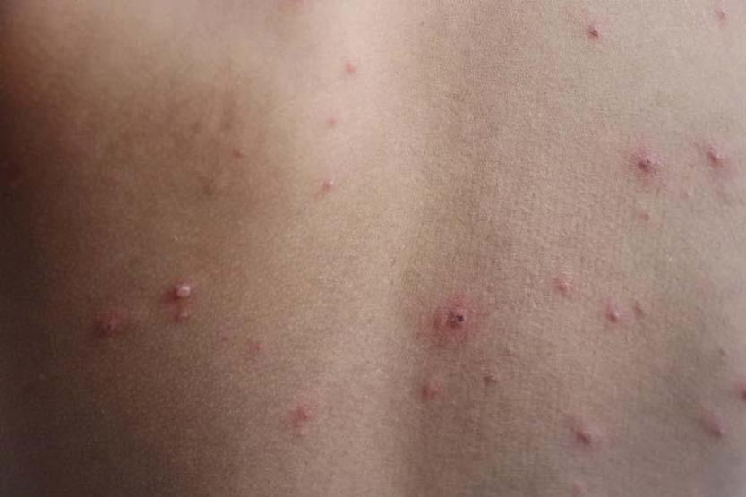 Araştırma: Enfeksiyon Belirtisi Olan Kişileri Görmek Bağışıklık Sistemini Tetikliyor