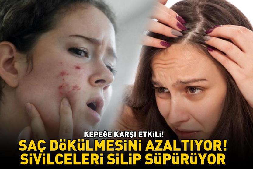KEPEĞE KARŞI ETKİLİ Saç dökülmesini azaltıyor; ciltteki bakteriyel sorunları, akne ve sivilceleri silip süpürüyor