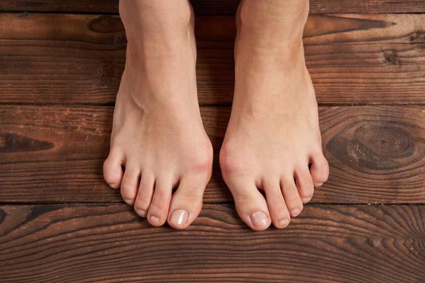 Her 3 Kadından 1’inin Sorunu: Ayak Başparmağında Kemik Çıkıntısı Sebebi Yüksek Topuklu ve Dar Ayakkabılar Olabilir