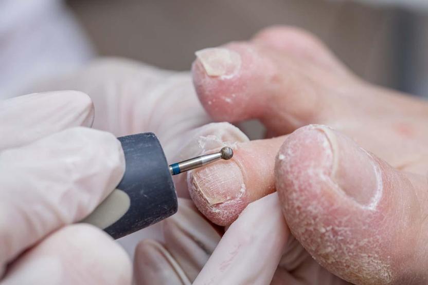 Şeker Hastalarına Uyarı: Tırnaklarınızı Böyle Kesiyorsanız Aman Dikkat Ayak Enfeksiyonuna Zemin Hazırlıyor