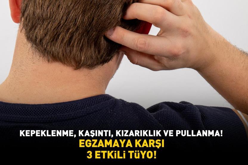 Kepeklenme, kaşıntı, kızarıklık ve pullanma EGZAMAYA KARŞI 3 ETKİLİ TÜYO