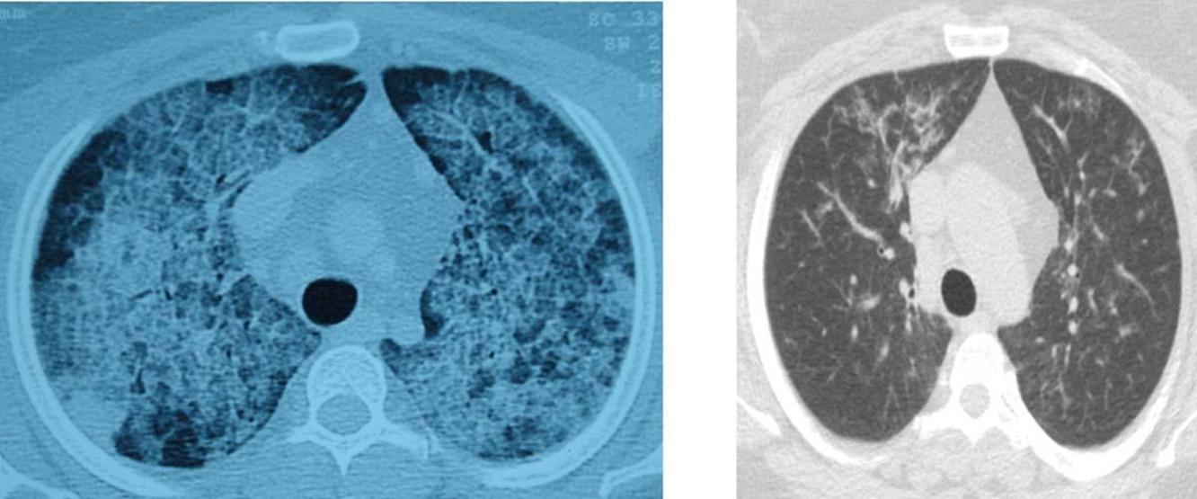 AKCİĞERDE 3 KRİTİK TEHLİKE ALARMI Yağ Birikmesi Sonucu Ortaya Çıkıyor, Öksüz Hastalıklar Olarak Biliniyor Nefes Aldıran Tedavi: Akciğer Yıkama Yöntemi Akciğer Yıkama Yöntemi Nedir, Nasıl Uygulanır