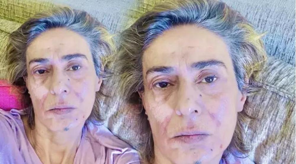 Yıldız Tilbe’nin Yüzüne Ne Oldu Son Paylaşımı Sevenlerini Korkuttu