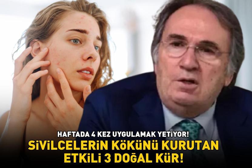 Prof. Dr. İbrahim Saraçoğlu’ndan sivilcelerin kökünü kurutan etkili 3 kür HAFTADA 4 KEZ UYGULAMAK YETİYOR
