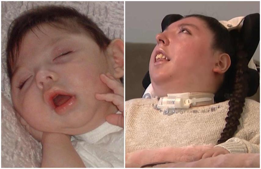 O bir savaşçı Doğuştan beyninin neredeyse tamamı yok: Doktorların 4 yıl ömür biçtiği Alex, 20 yaşında