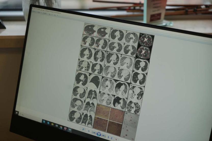 Kovid-19 Sonrası Gençlerde Ani Ölümler Arttı İşte Virüsün Vücutta Bıraktığı O Hasar 5 Yıllık Yaşlanmaya Eşdeğer