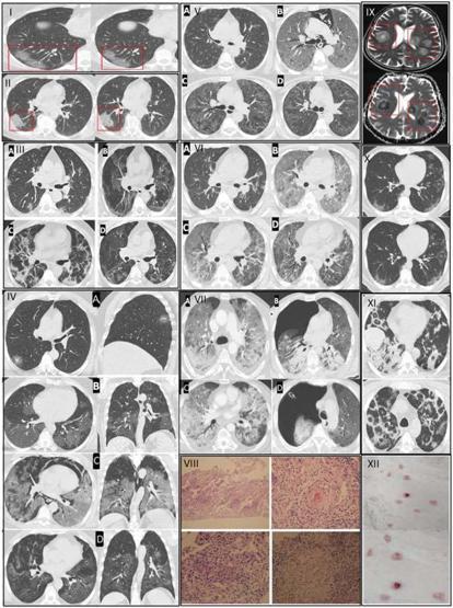 Kovid-19 Sonrası Gençlerde Ani Ölümler Arttı İşte Virüsün Vücutta Bıraktığı O Hasar 5 Yıllık Yaşlanmaya Eşdeğer