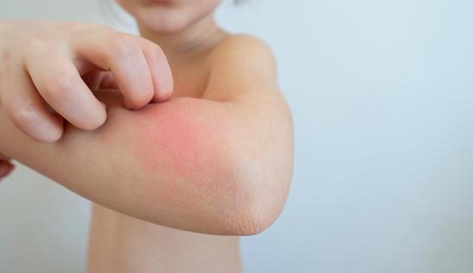 Çocuğunuzun Cildinde Kabarık ve Kızarık İzler mi Var Uzmanlar Uyardı: Kronik Ürtikere Dikkat