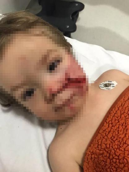 Ankarada pitbull dehşeti: Çocuğun yüzü paramparça oldu