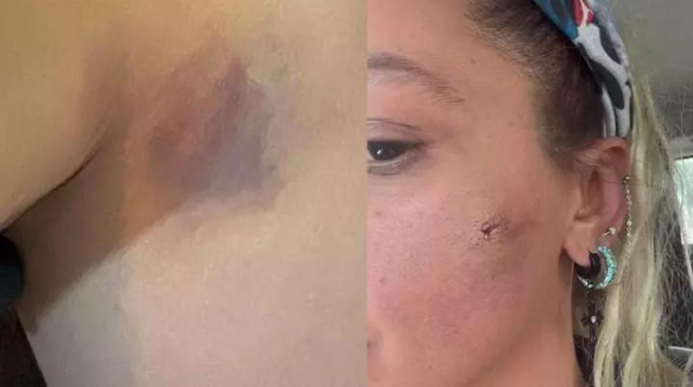 Yıldız Asyalı’dan Sarsıcı İtiraf “Eşim Tarafından Darp Edildim” Paylaşımı Sanal Medyada Gündem Oldu