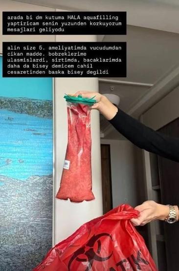 Danla Bilic yine ameliyat masasında Kalça dolgusu kabusu 5. operasyona kadar uzandı: Vücudundan çıkan madde şaşkına çevirdi