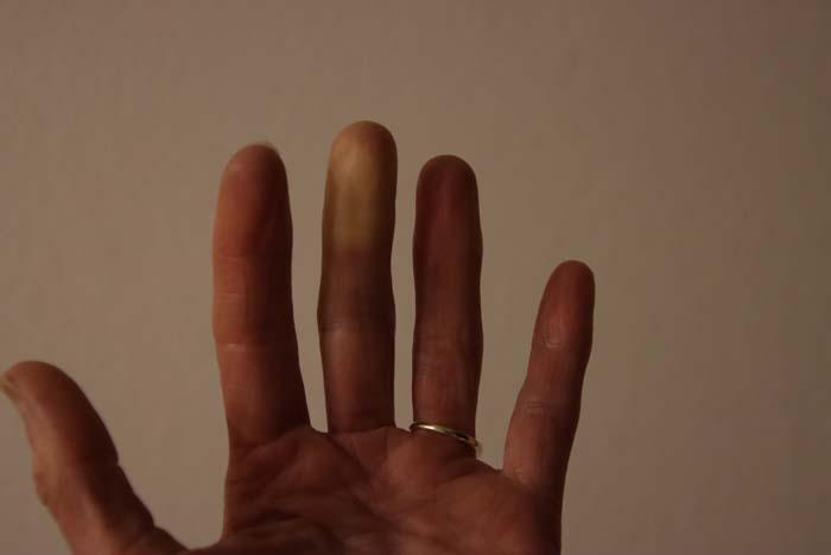 El ve Ayaklarda Aniden Oluşan Mavi-Mor Renk Değişimleri Bu Hastalığın Habercisi En Sık Bu Kişilerde Görülüyor