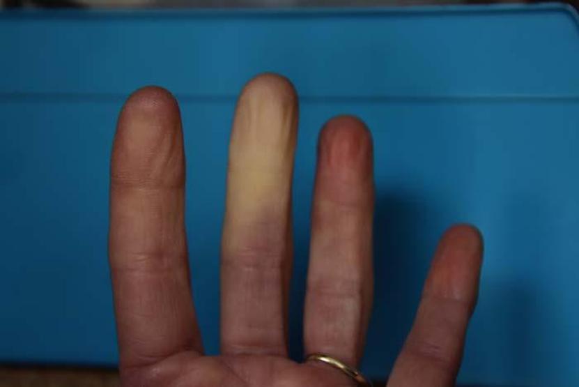 El ve Ayaklarda Aniden Oluşan Mavi-Mor Renk Değişimleri Bu Hastalığın Habercisi En Sık Bu Kişilerde Görülüyor