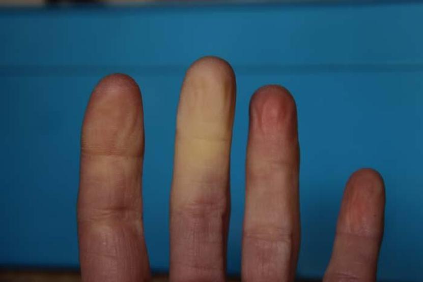 El ve Ayaklarda Aniden Oluşan Mavi-Mor Renk Değişimleri Bu Hastalığın Habercisi En Sık Bu Kişilerde Görülüyor