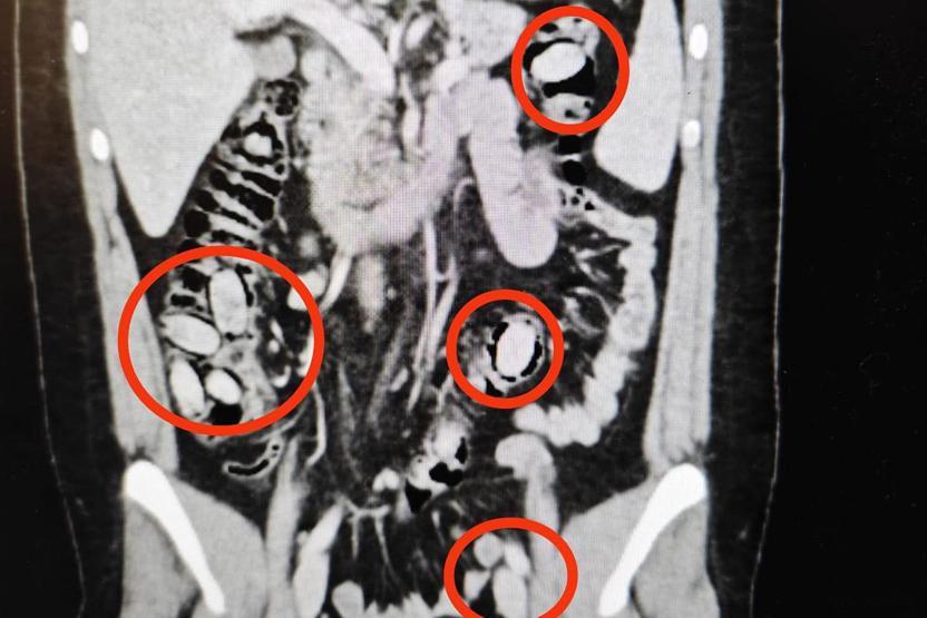 Polisin şüphesi üzerine durduruldu Midesinden çıkanlar şoke etti