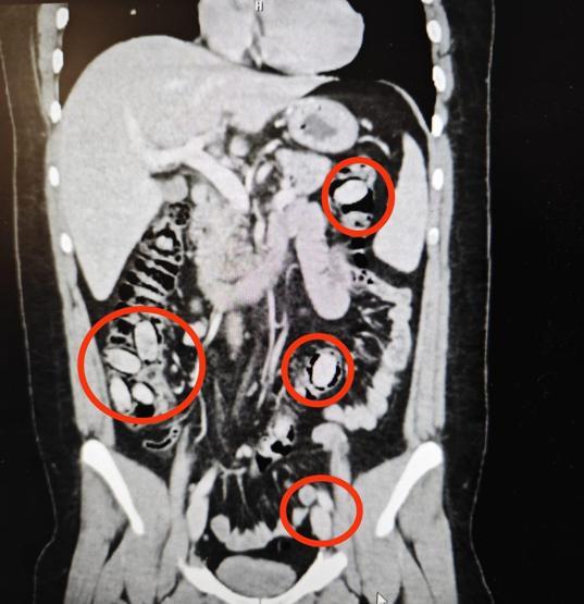 Polisin şüphesi üzerine durduruldu Midesinden çıkanlar şoke etti