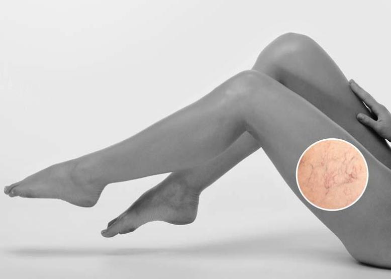 Lipödem: Ciddi Sağlık Sorunlarına Yol Açan Bir Metabolik Bozukluk Belirtiler, Türler ve Tedavi Seçenekleri