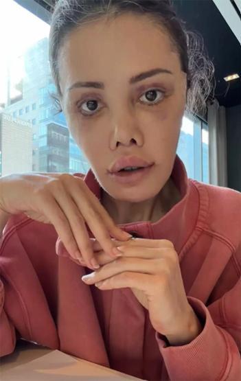 Yüz Nakli Yaptırmıştı Eski Survivor Yarışmacısı Didem Ceran Son Halini Paylaştı