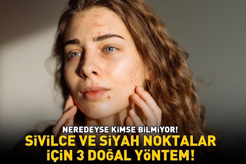 Siyah nokta, sivilce ve akneler için etkili 3 doğal yöntem Neredeyse kimse bilmiyor: Ciltteki yağı dengeliyor, gözenekleri sıkılaştırıyor