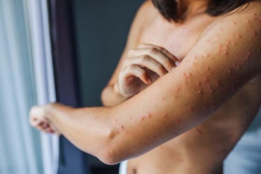 50 Yaş Üstüne Uyarı: Çocuklukta Uyuyan Virüs, Yıllar Sonra Sessizce Uyanıyor Yanma, Batma ve İzler… Zona’nın Gizemli Yolculuğu