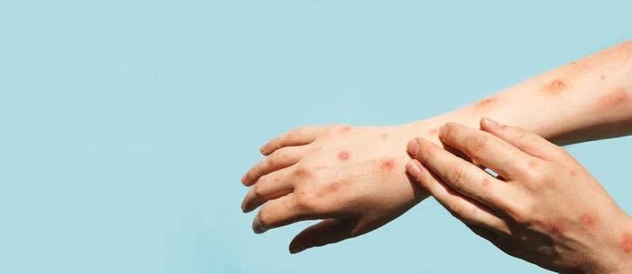 50 Yaş Üstüne Uyarı: Çocuklukta Uyuyan Virüs, Yıllar Sonra Sessizce Uyanıyor Yanma, Batma ve İzler… Zona’nın Gizemli Yolculuğu