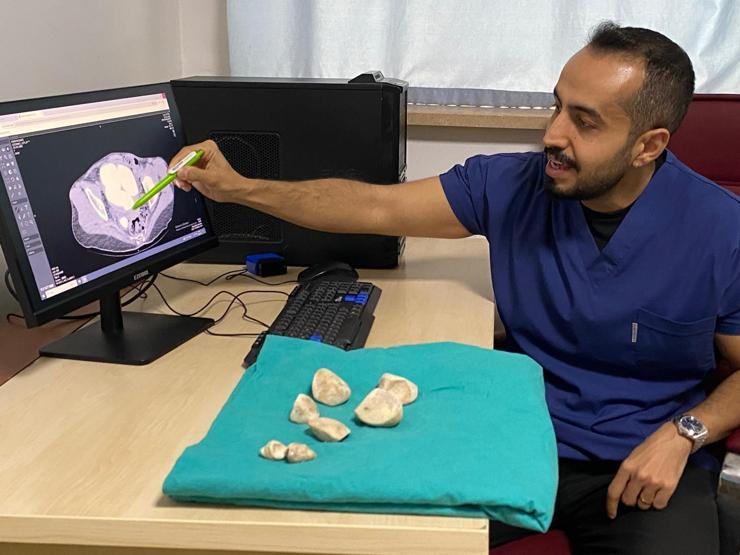 İdrar kanalı ve mesaneden yarım kiloya yakın 6 taş çıkarıldı Doktorlar bile şaşkına döndü