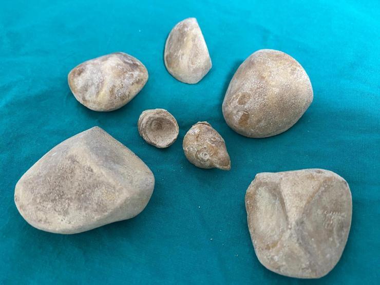 İdrar kanalı ve mesaneden yarım kiloya yakın 6 taş çıkarıldı Doktorlar bile şaşkına döndü