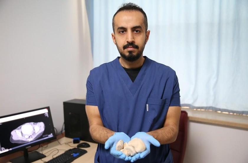 İdrar kanalı ve mesaneden yarım kiloya yakın 6 taş çıkarıldı Doktorlar bile şaşkına döndü