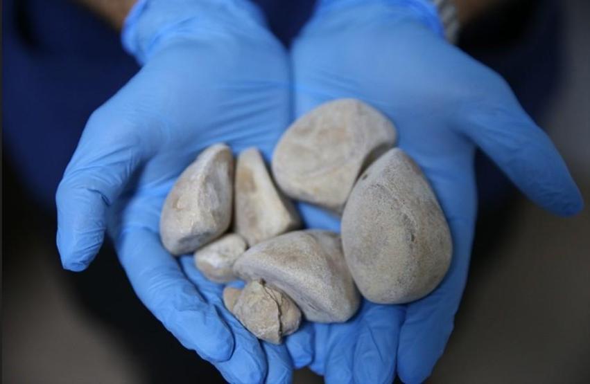 İdrar kanalı ve mesaneden yarım kiloya yakın 6 taş çıkarıldı Doktorlar bile şaşkına döndü