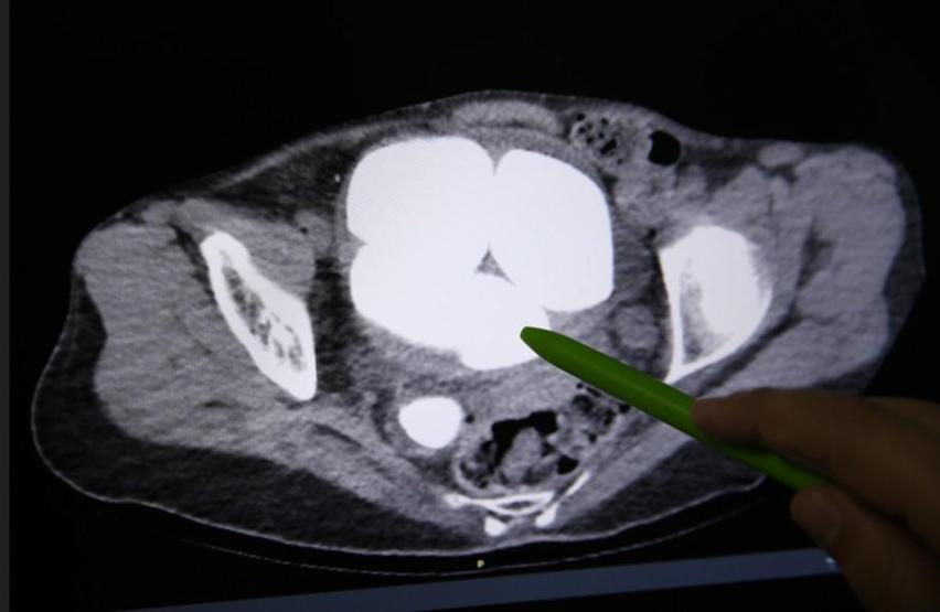 İdrar kanalı ve mesaneden yarım kiloya yakın 6 taş çıkarıldı Doktorlar bile şaşkına döndü
