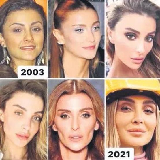 Özge Ulusoy’dan Yıllar Sonra Gelen İtiraf: Estetik Operasyon Kararının Perde Arkasını Anlattı