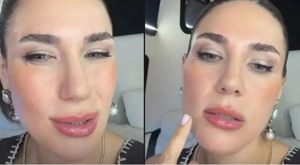 Buse Varol’dan Estetik Açıklaması: “BOTOKSU İKİ GÜN ÖNCE YAPTIRDIM”