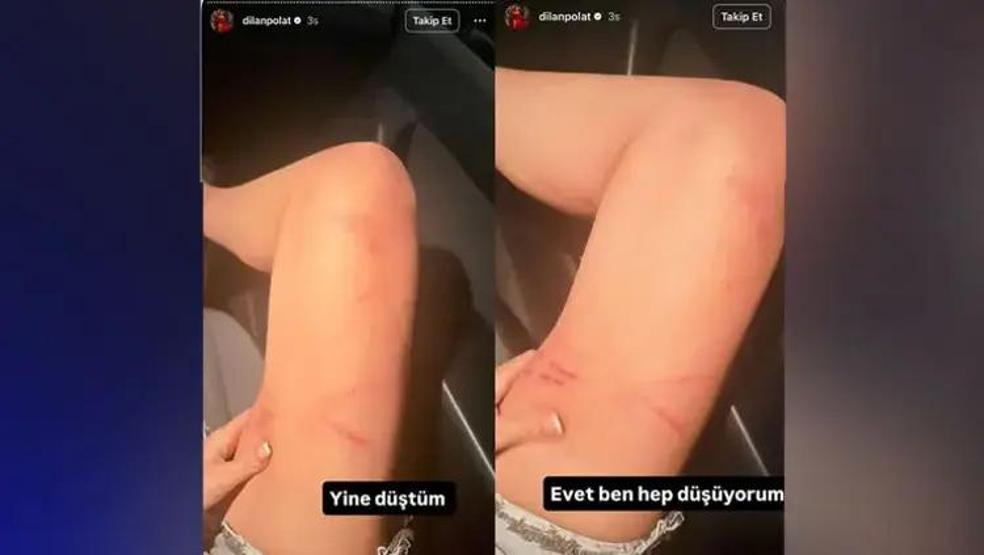 Barışma Tatili Krizle Bitti Dilan Polat’tan Şoke Eden Paylaşımlar: Darp İzlerini Paylaşıp Sildi