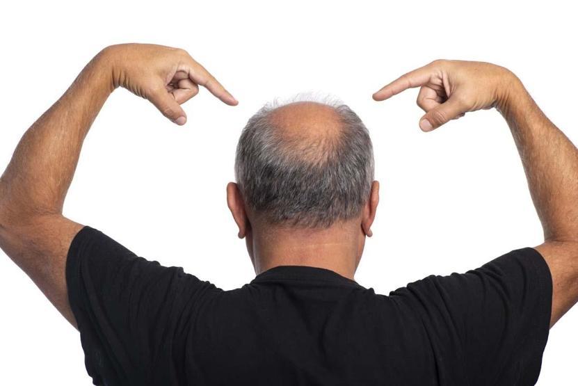YILLARDIR BİLİNİYORDU, BİLİM DOĞRULADI: Saç Dökülmesine Karşı Doğadan Gelen Umut Bu Kök Yeniden Gündemde