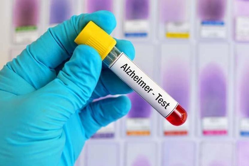 ALZHEİMER BÖYLE BAŞLIYOR Demansın SİNSİ İZLERİNİ Ortaya Çıkaran İLK İPUCU Açıklandı Anlamanın Yolu İşte Bu Yöntemmiş Gözle Görülmeyen DEMANS Sinyalleri