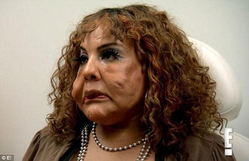 Yüzüne çimento ve lastik dolgu macunu enjekte edildi