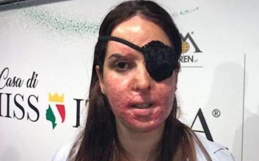 Güzellik kraliçesine asitle saldırmıştı Cezası belli oldu