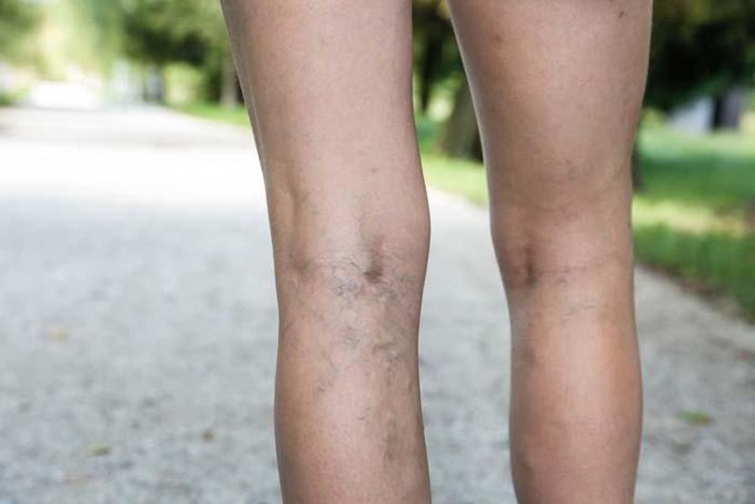 Bacak şişliğini sadece varis sanmayın Ödem ciddi hastalıkların ilk işareti olabilir