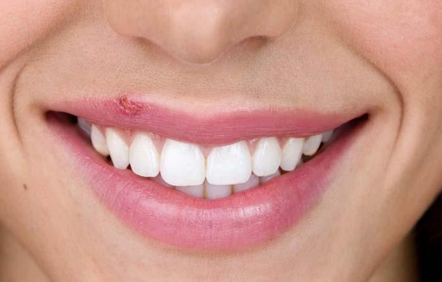 Cildiniz sağlığınızı ele veriyor! Geçmeyen uçuk, yara ve sivilcelerin nedeni bunlar olabilir