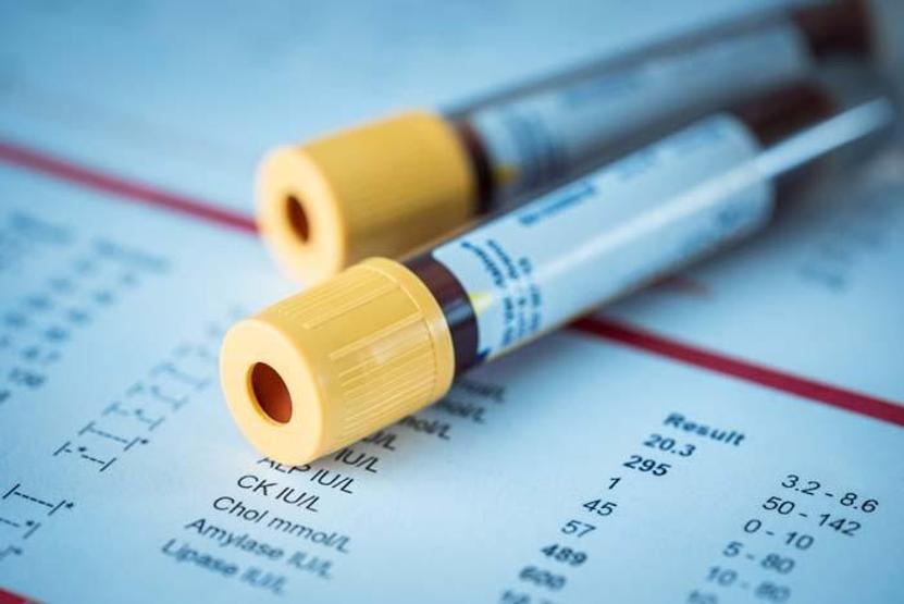 Kanınızdaki bu tehlikeye dikkat İşte demans riski %82den fazla olan kan grubu