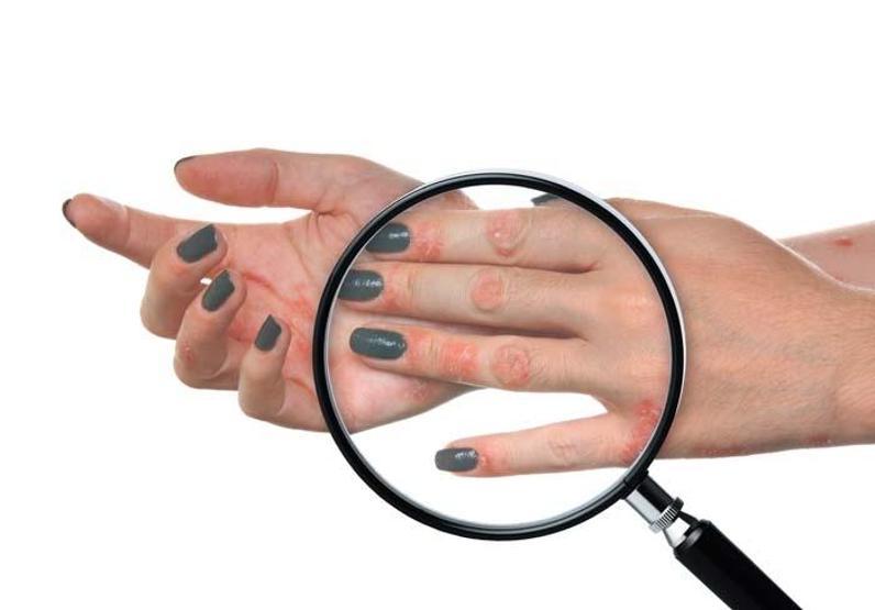 Sedef hastalığı nedir Belirtileri ve tedavi yöntemleri