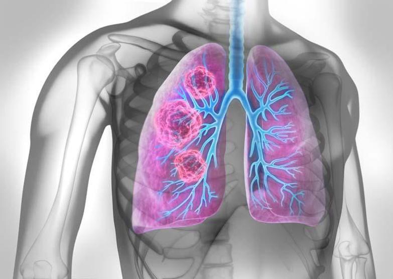 Asbest maruziyetinin yol açtığı hastalık: Mezotelyoma
